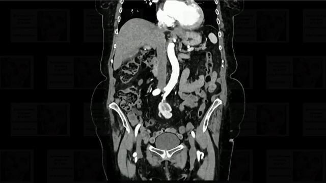 Тазовая почка смотреть онлайн