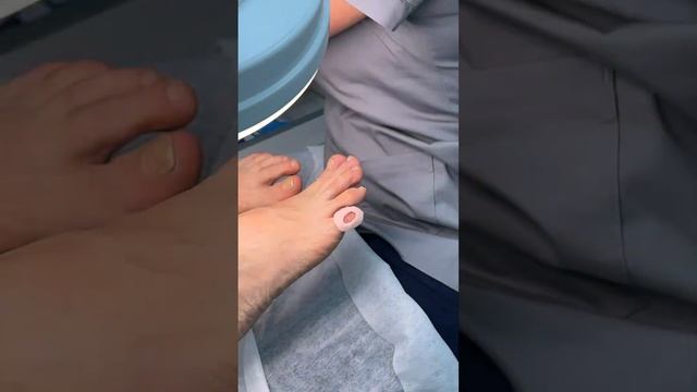 Удаление стержневой мозоли. Наложение разгрузочной повязки