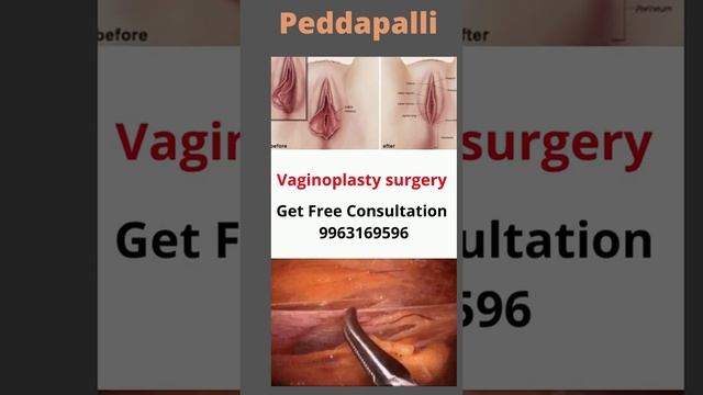 Vaginoplasty treatment surgery treatment in Peddapali,surgery hospital in Peddapali