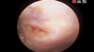 #Опухоль твердого неба #Карцинома полости #рта