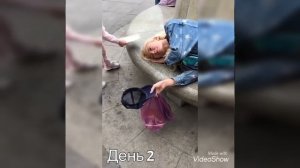 Круговая блефаропластика. Результаты до и после.