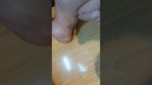 перелом ноги,перелом пятой плюсневой кости