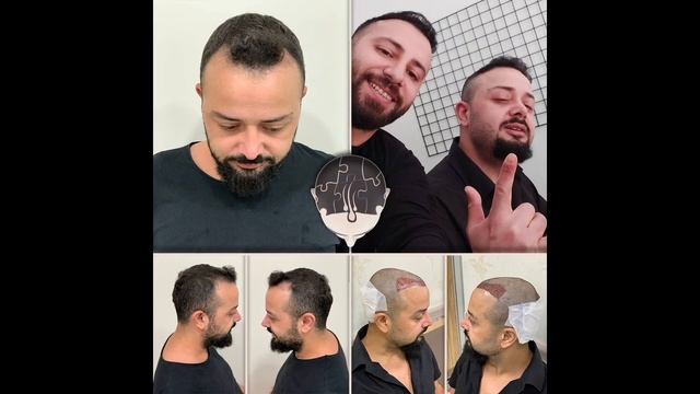 Estehair. Turkey este hair dobrovvalya. Операция по пересадке волос. Зеленые банды ставрополье. Turkey este hair dobrovvalya.