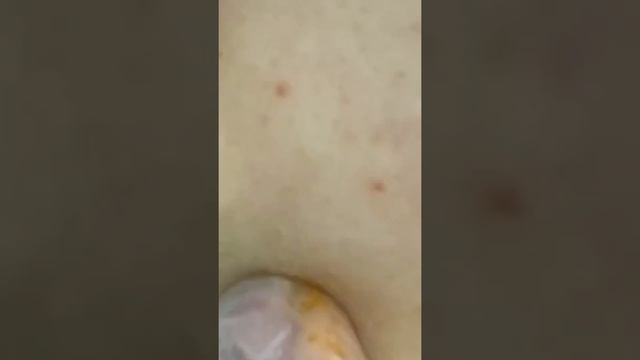 Давить прыщи// кайф для глаз//blackhead whiteheads removal// чёрные точки