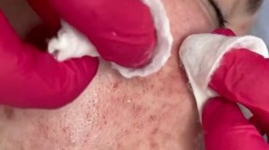 blackhead extraction | removing cystic acne | чёрные точки | прыщи выдавливание| акне |угри