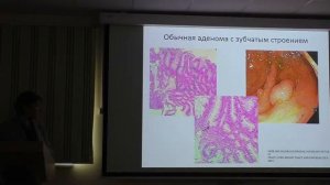 15 Крайнова ЕА Биопсийная диагностика и исследование материала эндоскопических новообразований резе