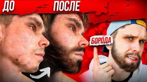 Лучший Способ Отрастить МУЖИЦКУЮ БОРОДУ! МИНОКСИДИЛ (minoxidil)