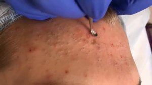 blackhead extraction  | removing cystic acne | чёрные точки | прыщи выдавливание | акне