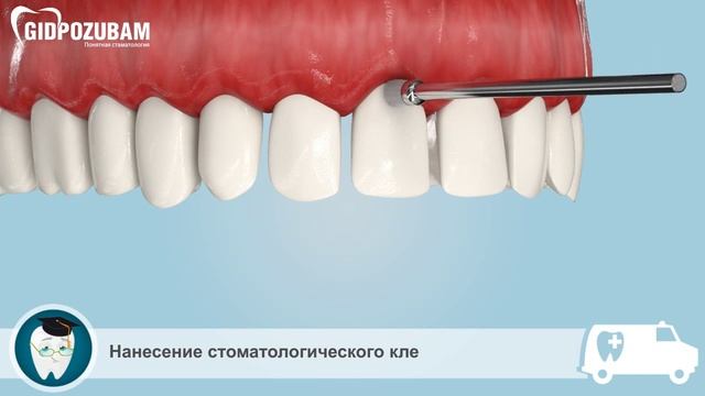 Виниры. Исправление кривизны зубов при помощи виниров смотреть онлайн