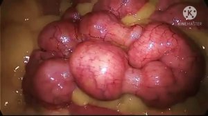 Перистальтика—это серия упорядоченных сокращений кишечника, которые проталкивают пищу через кишечни