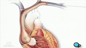 Имплантация кардиостимулятора