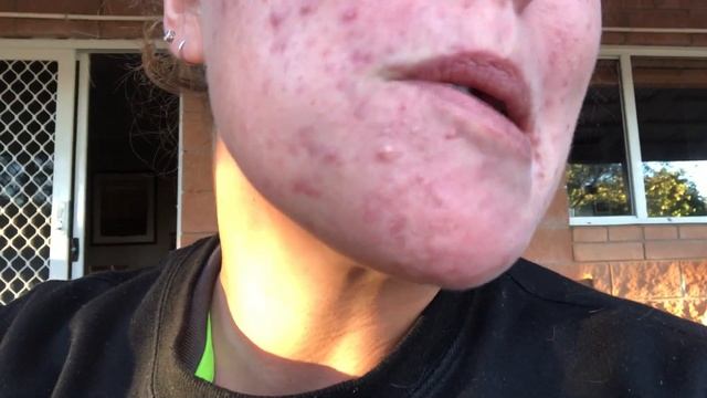 ACNE & Doxycycline - First 4 weeks - Update смотреть онлайн