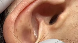 How to clean Milia in the ears?