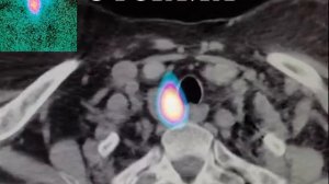 Однофотонная эмиссионная компьютерная томография совмещенная с компьютерной томографией