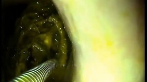 Эндоскопическое удаление инородного тела