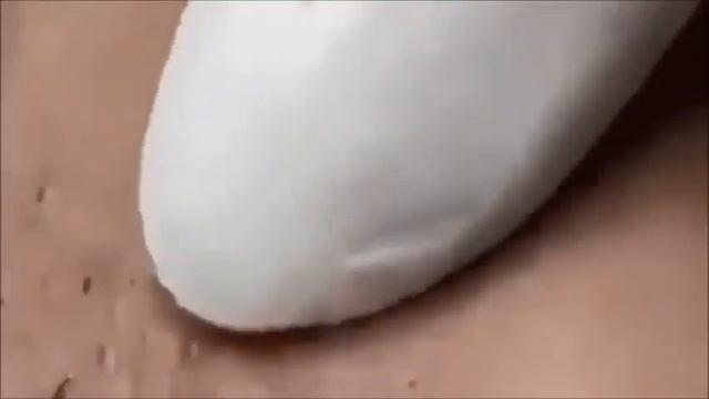 Who likes to squeeze blackhead popping? Quem gosta de espremer cravos? смотреть онлайн