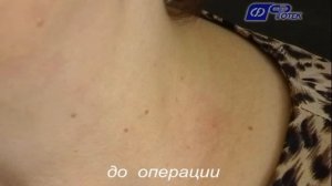 Применение аппаратов ФОТЕК в косметологии