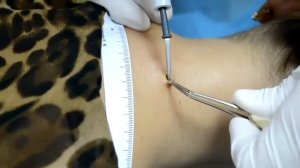 Невус, удаление методом высокочастотной электрохирургии