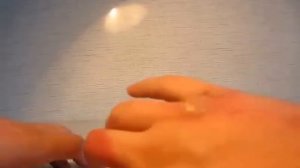 ЖЕСТЬ! Ожоги от борщевика ll-степени. Как быстро свести?