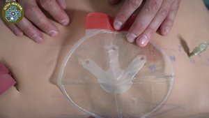 Пневмоторакс Окколюзионная повязка