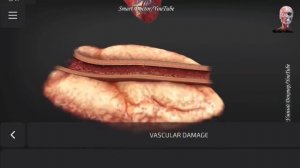 Heart Attack. Coronary artery disease (CAD) myocardial infarction ❤️. ?.mp4