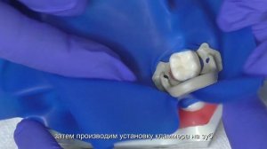 Методика наложения коффердама  способ 3