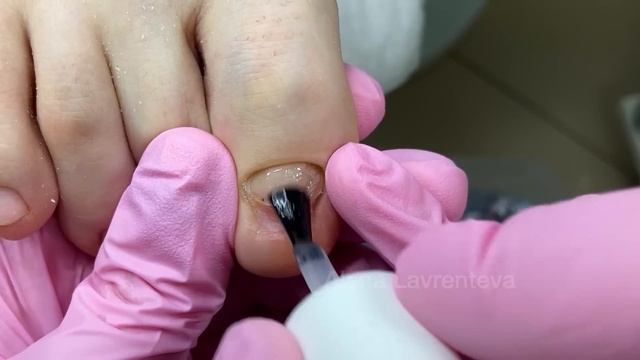 Проблемный ноготь Ноготь не прирастает что делать? Ноготь на ноге не растет Экзостоз? Зачистка ногт смотреть онлайн