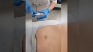 Липолитики. Липосакция без ножа.