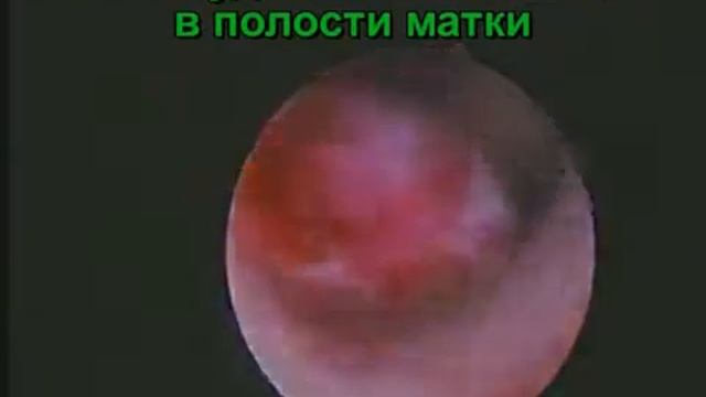 Эндоскопическое удаление полипов эндометрия в постменопаузе