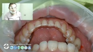 Professional oral hygiene - case 001 Acteon, DTE, Dentsply, Coxo, Floweis, 3M, KerrHawe (livestream