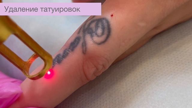 Удаление татуировок #удалениетату #удалениетатуировок