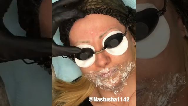 Удаление некачественного татуажа бровей и губ неодимовым лазером ScinOne Ultra II смотреть онлайн