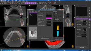 Выбор оптимального положения импланта в Implastation. Урок 6
