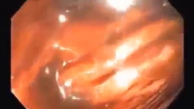 Колоноскопия Кишечника смотреть онлайн