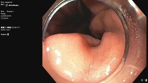 Крупная фиксированная аксиальная хиатальная грыжа.