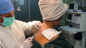 Липосакция шейного отдела