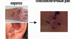 Рак кожи. Сыпь. #раккожи#сыпь#подготовкакusmle