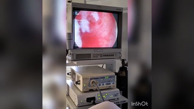 Гистероскопия, удаление полипа эндометрия. Hysteroscopy, polypectomy