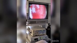 Гистероскопия, удаление полипа эндометрия. Hysteroscopy, polypectomy