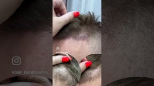 Трихопигментация по методу SMP после пересадки волос.