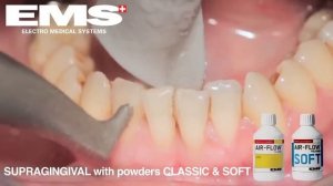 Чистка зубов системой Air Flow