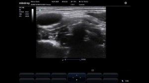 Диссекция позвоночной артерии (УЗИ)