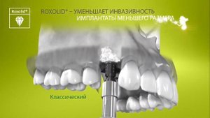 Импланты Straumann (Швейцария)