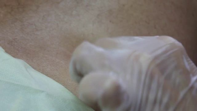 Удаление кератомы на спине