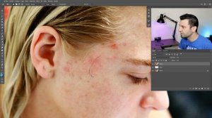 3 Pasos para Quitar Granos de Acné en Photoshop