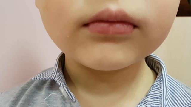 Как определить длину уздечки? Короткая уздечка языка и норма