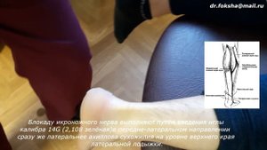 Техника блокады лодыжки | Блокада икроножного нерва по Брауну | Sural Nerve Block