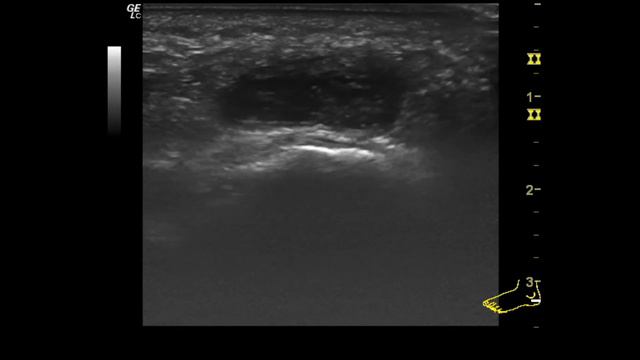 Боль в пятке и УЗИ смотреть онлайн