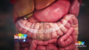 Запоры. Как нормализовать стул? Жить здорово! Фрагмент выпуска от 01.03.2017