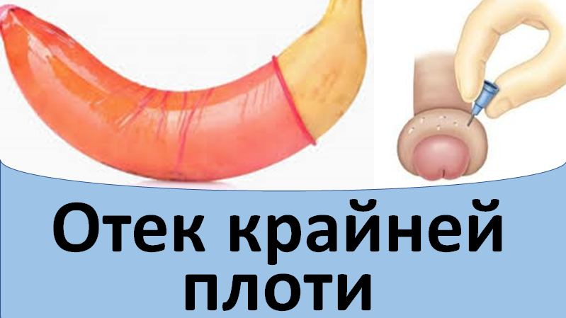 Отек крайней плоти